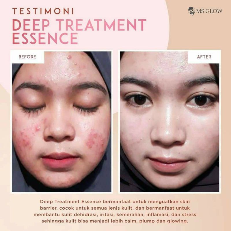 Ms Glow Deep Treatment Essence Ms Glow Original 100% Penghidrasi Mengembalikan Skin Barier Centella Asiatica Ms Glow Dte