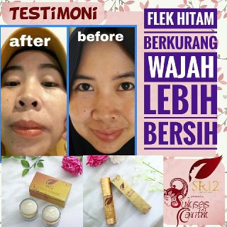 TUMPAS BEKAS JERAWAT , FLEK HITAM &amp; NODA WAJAH ..!! SPOT ESSENCE DAY &amp; NIGHT CREAM SR12 STANDAR BPOM