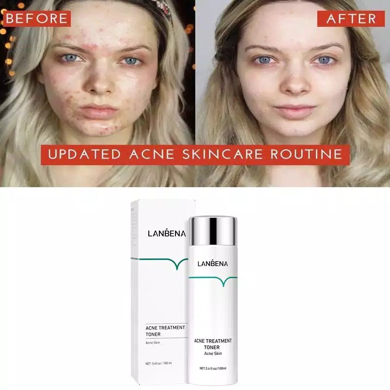 LANBENA Toner Acne Anti Jerawat Treatment Untuk Memperbaiki Kulit ORI