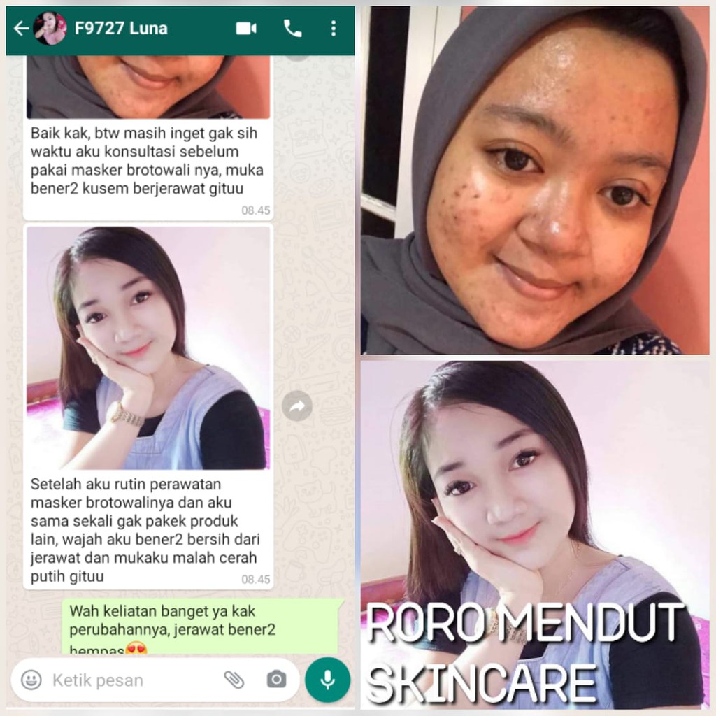 Masker Brotowali Penghilang Jerawat Bekas Jerawat Pencabut Komedo Roro Mendut Mini Acne Jerawat 20gr