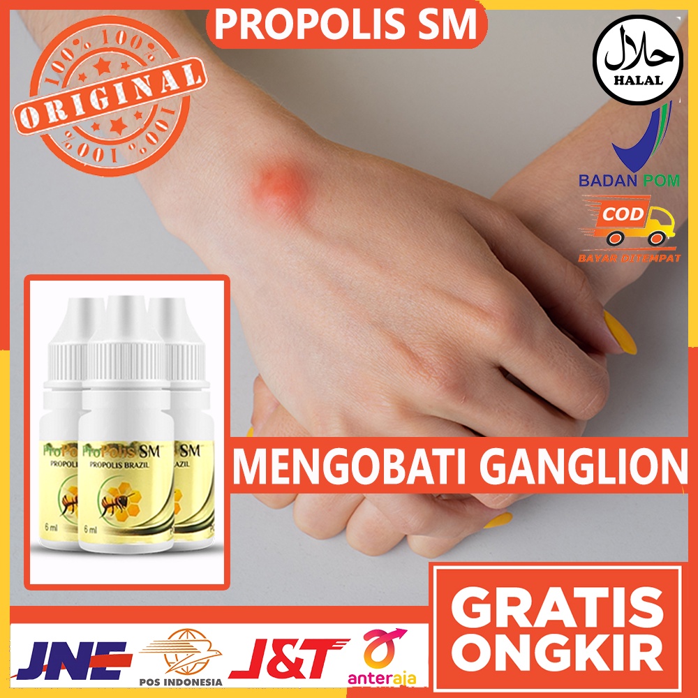 Obat Alami Ganglion - Obat Benjolan di Tangan - Obat Benjolan Ganglion - Obat Benjolan di pergelanga