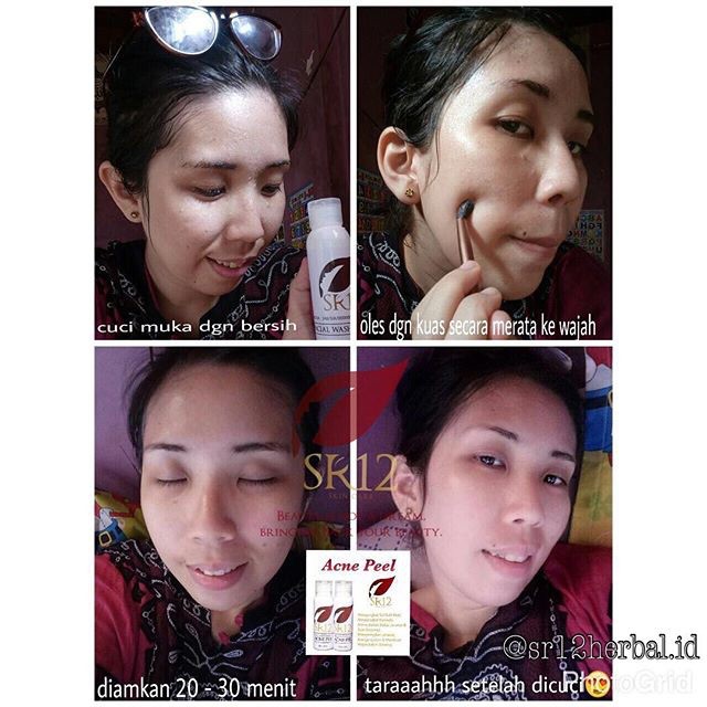 CHEMICAL PEELING ACNE SR12 - ACNE PEEL SOLUSI BOPENG SCAR BHA 30% HILANGKA BEKAS JERAWAT dan bruntus