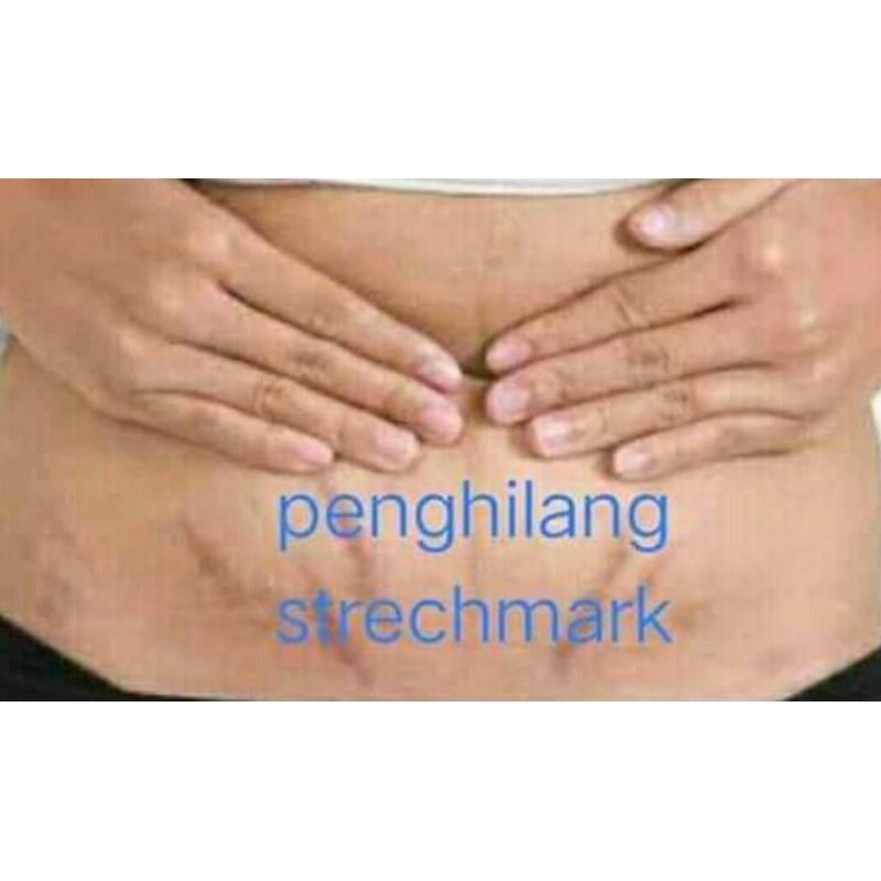 MENGHILANGKAN STRECHMARK