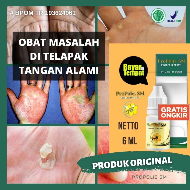 Obat Tetes Kutu Air Di Telapak Tangan Gatal dan Bintik Bintik Berair, Obat Kutu Air Di Sela Jari Kak