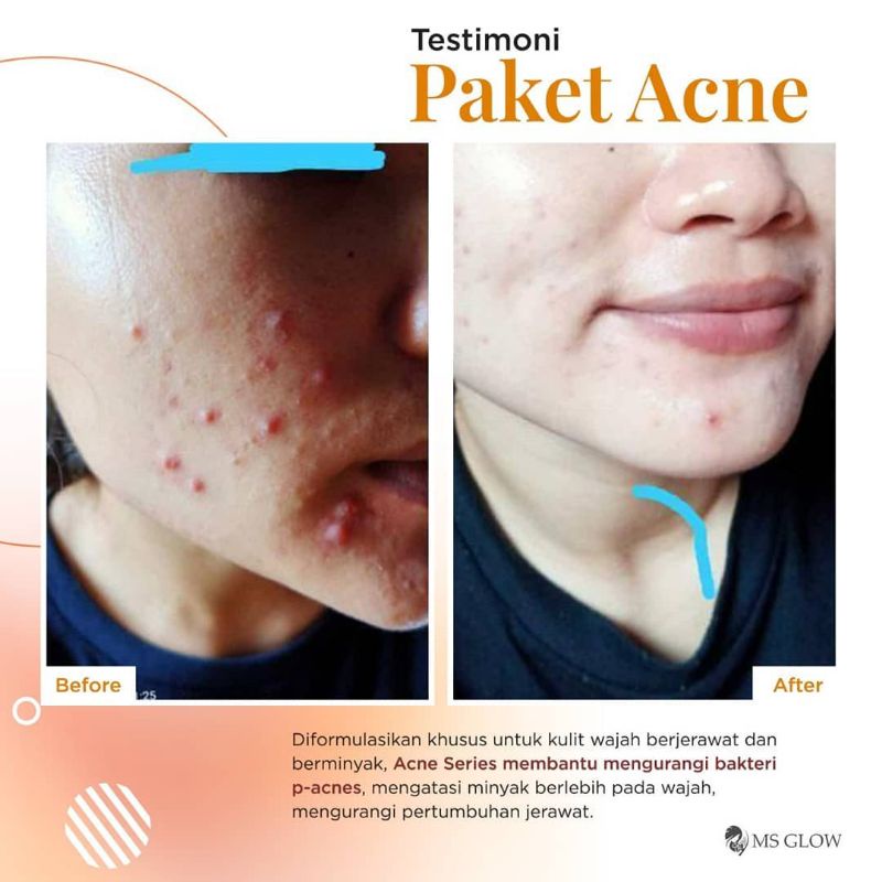 Ms Glow Paket Acne Free Pouch