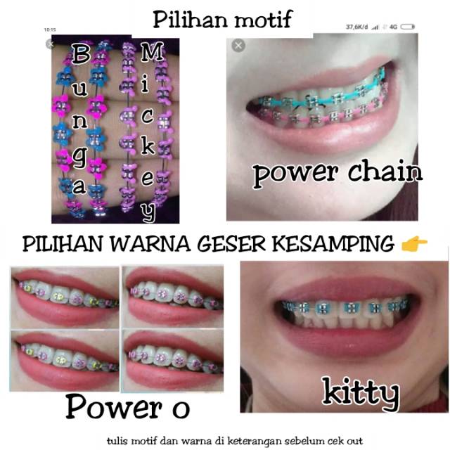  Warna  Karet  Behel  Power Chain Yang  Lagi  Trend 