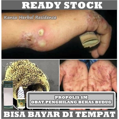 Obat Borok Budug Di Kaki, Cenang Bernanah, Cenang Di Tangan, Cenang Di Telapak Tangan, Obat Gatal Bernanah, Kulit Nanahan, Luka Borok Bernanah, Cenang Berair, Salep Penghilang Cenangan, Salep Buat Koreng, Benjolan Nanah Di Jari Jari Tangan