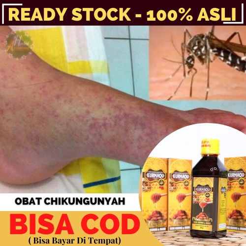 Obat Herbal Chikungunya, Demam & Sakit Kepala Chikungunya, Nyeri sendi Akibat Chikungunya | KURMAQU