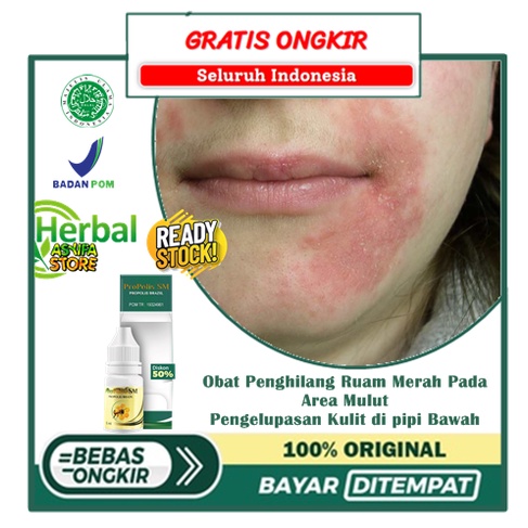 Obat Penghilang Ruam Merah Pada Area Mulut, Pengelupasan Kulit di pipi Bawah, Obat Angular cheilitis