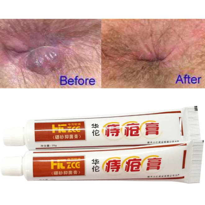 Salep Wasir Ambeyen Ambeien Bab Ampuh Asli Cina Huatuo Zhichuang Gao - Salep Huatuo Cl460