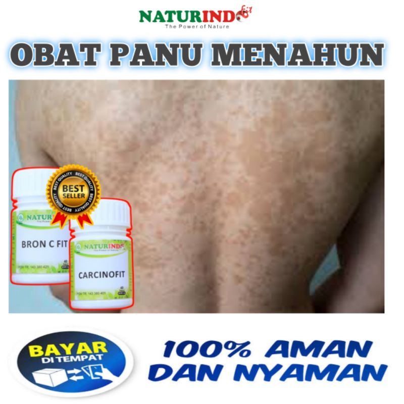 Jual Obat Penghilang Panu Menahun Hapur Besi Panu Membandel Buras Panu