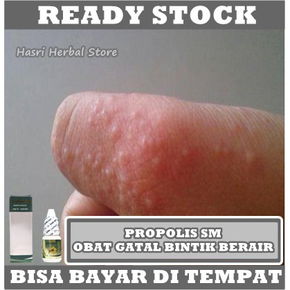 Obat Gatal Berair di Jari Tangan dan Kaki, Gatal Bintik Berair, Gatal Bernanah, Kaki Gatal Berair, Tangan Gatal Berair, Kutu Air, Gatal Kulit Berair, Luka Gatal Berair, Bentol Berair, Salep Gatal Berair Dengan Propolis SM Asli Ori