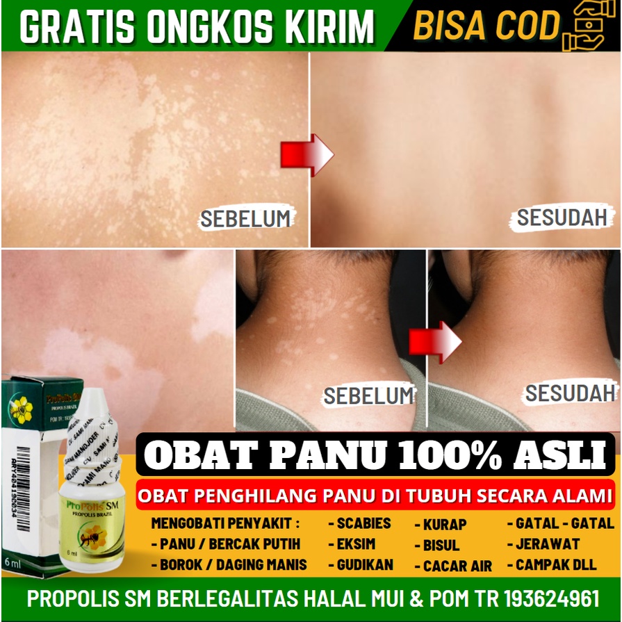 Obat Panu Asli, Obat Kadas, Obat Kurap, Hapur,a Obat Oles Panu, Penghilang Panu, Propolis SM Herbal