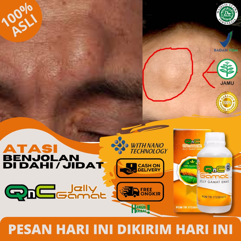 Obat Pengempis Benjolan Di Dahi/Di Jidat, Penghilang Benjolan Lipoma, Kista, Dan Tumor - QNC JELLY G