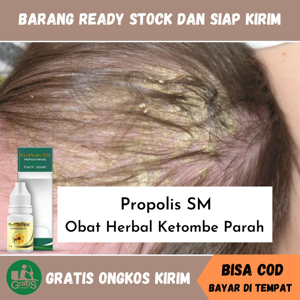 Obat Ketombe Parah, Gatal Ketombe, Jamur Di Kulit Kepala, Ketombe Berkerak/Membandel - Propolis SM