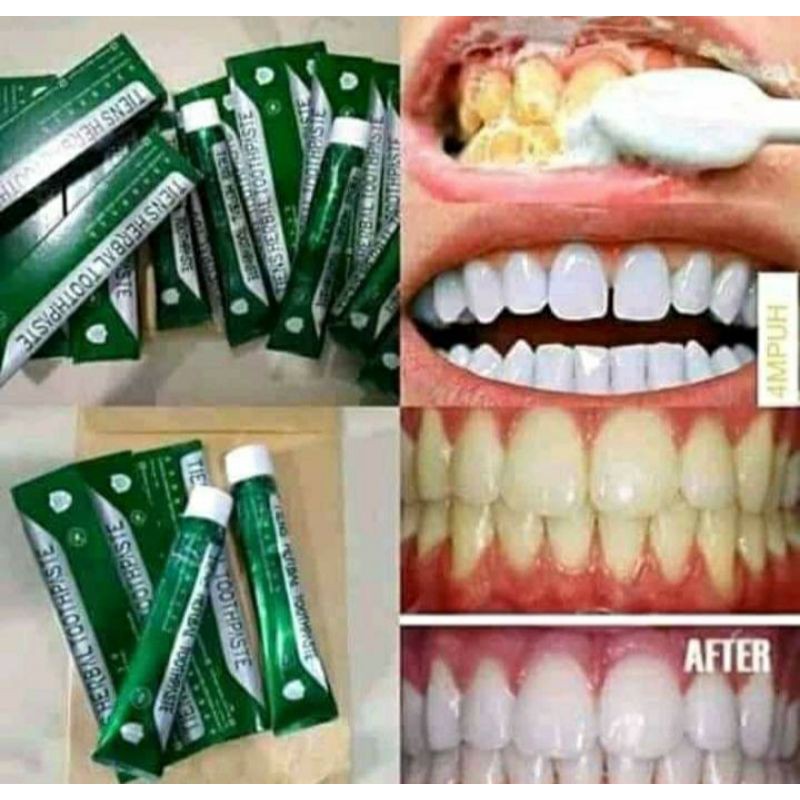 PERONTOK KARANG GIGI