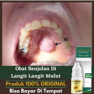 Jual Obat Benjolan Di Langit Langit Mulut- Benjolan Tulang Di Langit ...