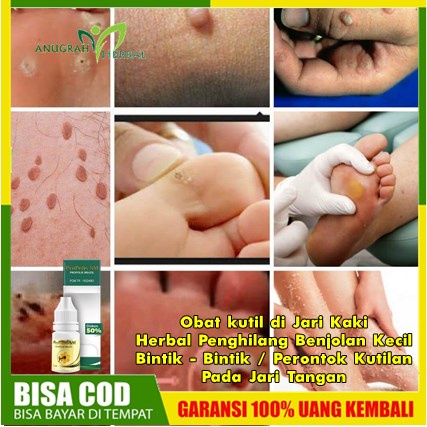Obat kutil di Jari Kaki, Herbal Penghilang Benjolan Kecil, Bintik - Bintik / Perontok Kutilan Pada J