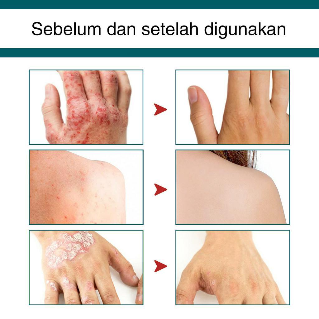 [100% Asli ] Obat gatal kulit Obat gatal paling ampuh Obat gatal selangkangan 30g Bakteriostasis herbal/Eksim membandel/Kulit gatal/Gatal di selangkangan/Krim Antipruritic Seluruh Tubuh