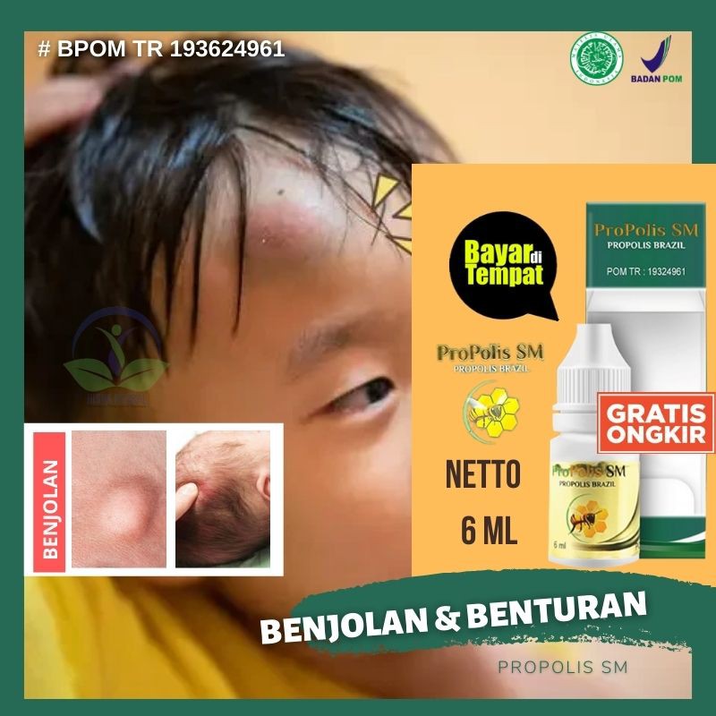OBAT BENJOLAN DI KEPALA PENGHANCUR LIPOMA DI LEHER, PANTAT, JIDAT DAHI KAKI DAN TANGAN - PROPOLIS SM