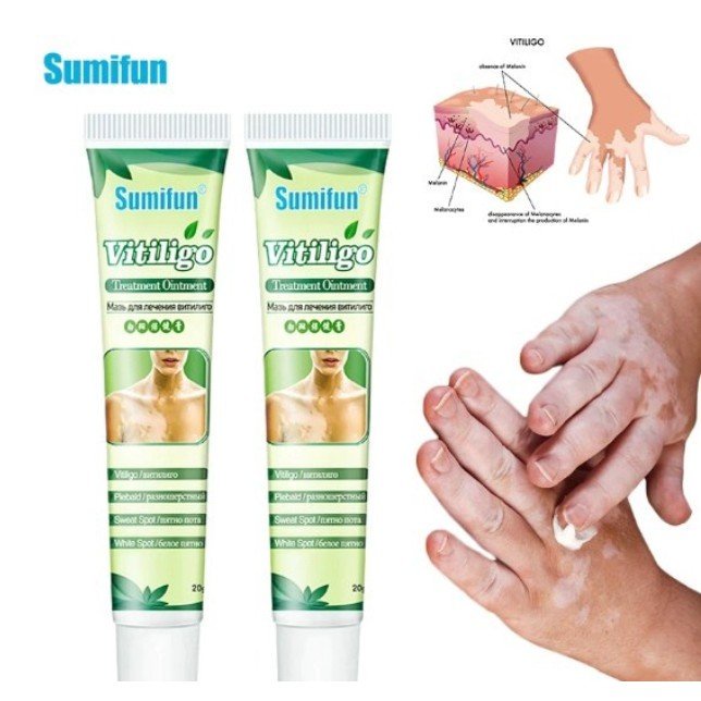 OBAT VITILIGO & LEUKOPLAKIA & SALEP VITILIGO & SALEP LEUKOPLAKIA BERKAT
