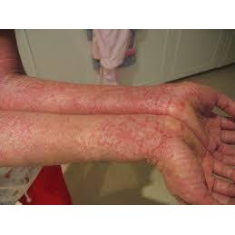 salep obat gatal kulit akibat alergi semen dan lain lain paling ampuh