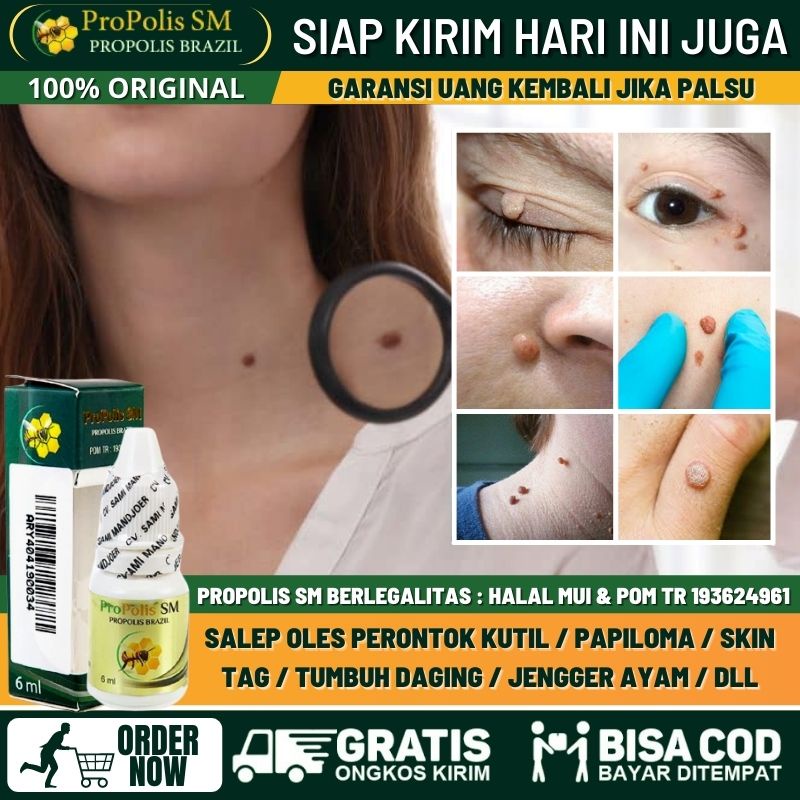 Obat Penghilang Skin Tag di Wajah / Kelopak Mata /  Leher / Telinga - Perontok Skin Tag Secara Alami