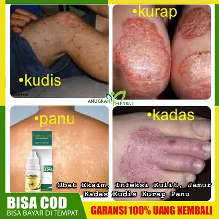 Obat Eksim, Infeksi Kulit, Jamur, Kadas Kudis Kurap Panu di Selangkangan, Ketiak, Leher, Pantat OLES