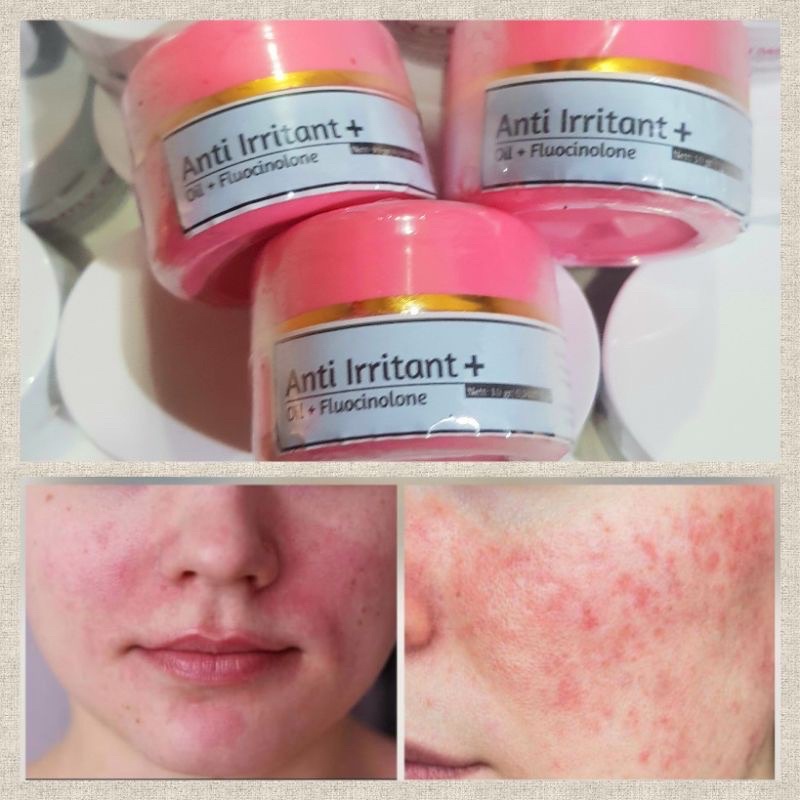 CREAM ANTI IRITASI || COOLING CREAM || CREAM IRITASI WAJAH