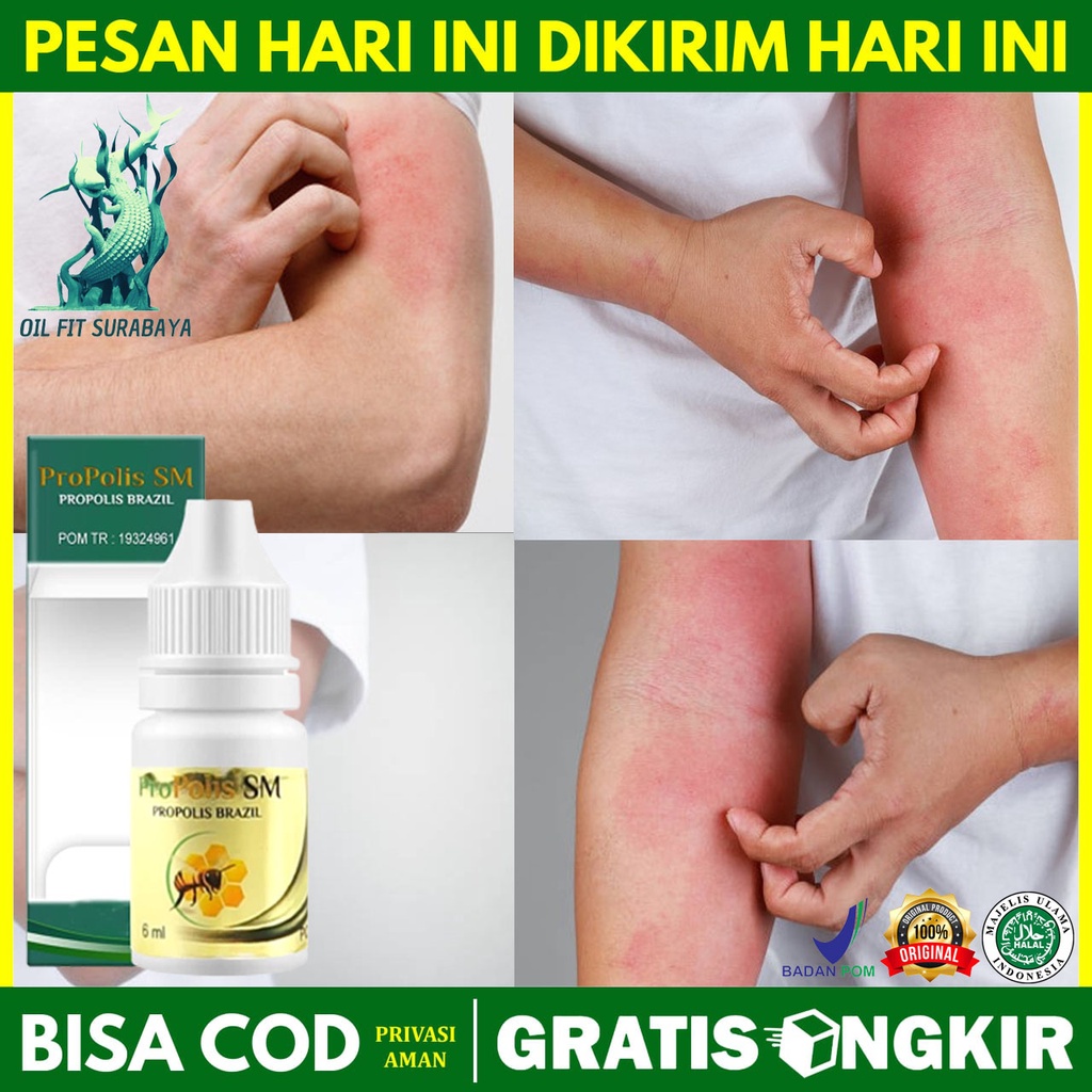 Obat Gatal Pada Kulit Tapi Tidak Bentol Gatal Pada Kulit Seperti Terkena Ulat Bulu Gatal Pada Kulit 