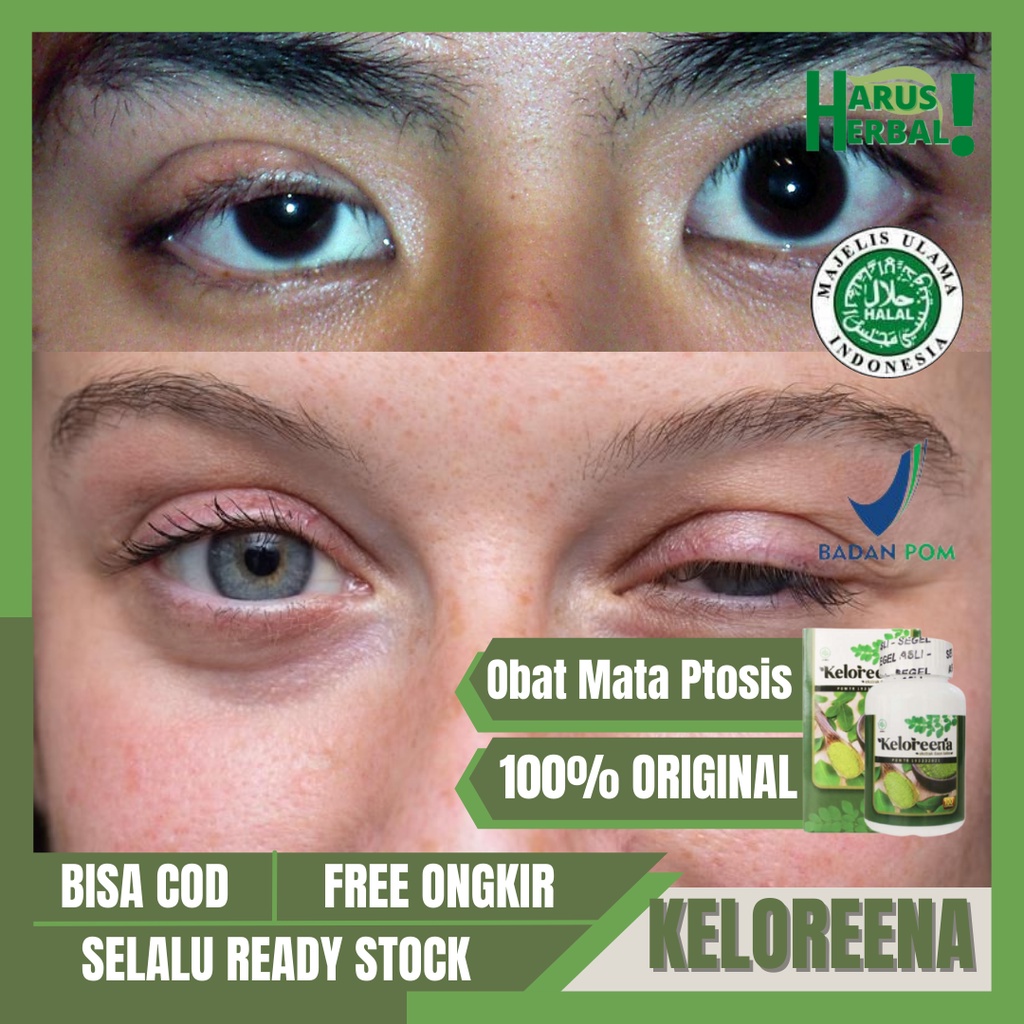 Obat Mata Ptosis KELOREENA, Kelopak Mata Turun Sebelah, Obat Mata Sipit Sebelah, Obat Kelopak Mata K