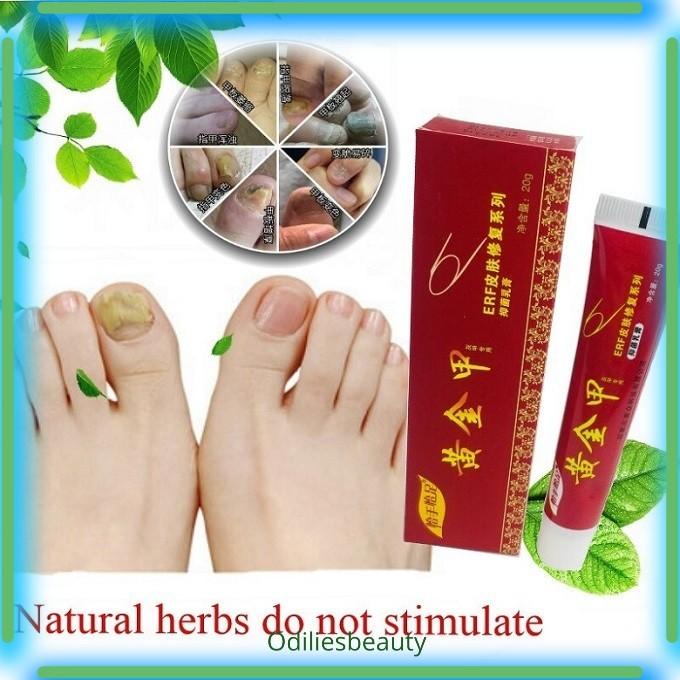 Miny | Salep Anti Jamur Kuku Onikomikosis Paronychia Herbal Cina 20 Gr