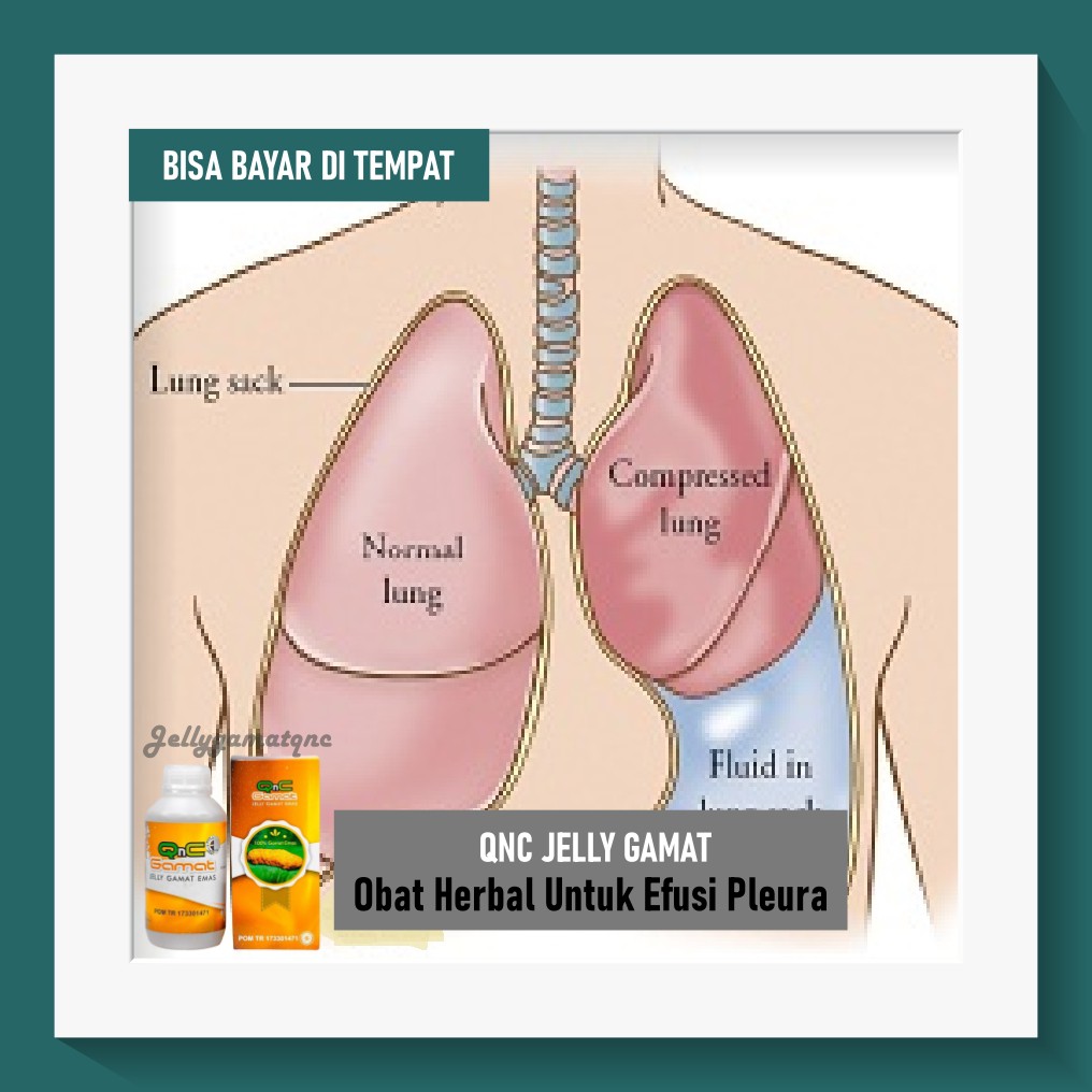 Obat Efusi Pleura, Cairan Paru-Paru, Obat Paru Paru Basah Herbal QnC Jelly Gamat