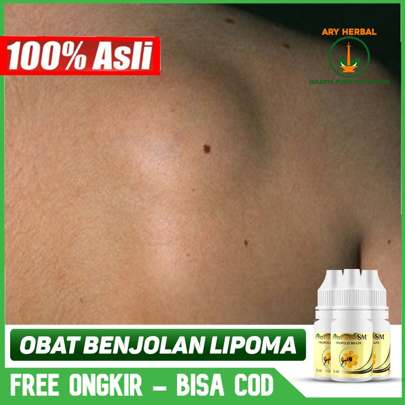 Obat Liver Bengkak, Liver Tetes, Terlaris - Herbal PROPOLIS SM Brazil ASLI Jakarta Pusat