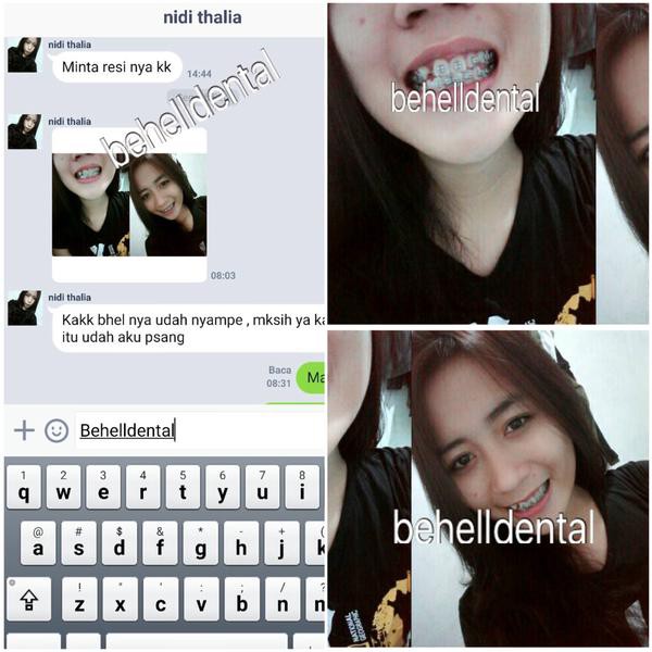 Paket Behel Gigi Permanen Murah Orthodontic Amplop | perawatan perbaikan . Kawat braces