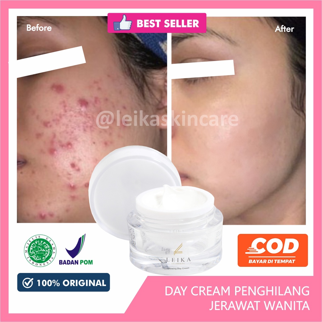 Obat Jerawat Paling Cepat dan Ampuh BPOM Obat untuk Kulit Wajah Berminyak Berjerawat Asli 100% dan Halal MUI Glowing Day Cream Leika Skincare 10gr Penghilang Jerawat Ampuh Aman Ori