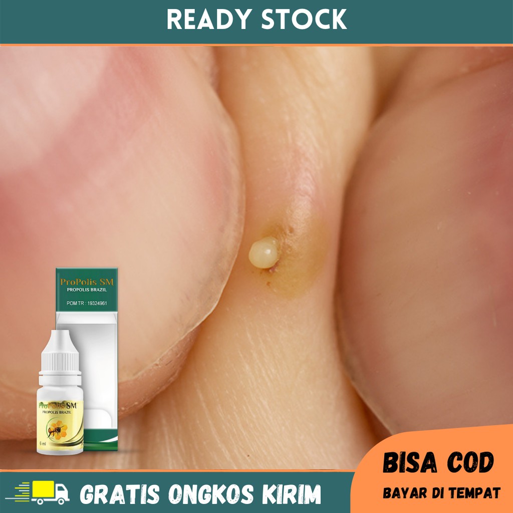 Obat Bisul Bernanah, Bisul Di Kemaluan, Bisul Di Kaki/Tangan, Obat Bisulan, Furunkel, Obat Herbal Ol