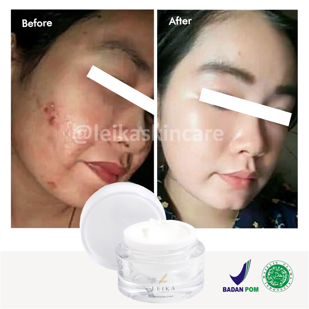 Obat Jerawat Paling Cepat dan Ampuh BPOM Obat untuk Kulit Wajah Berminyak Berjerawat Asli 100% dan Halal MUI Glowing Day Cream Leika Skincare 10gr Penghilang Jerawat Ampuh Aman Ori