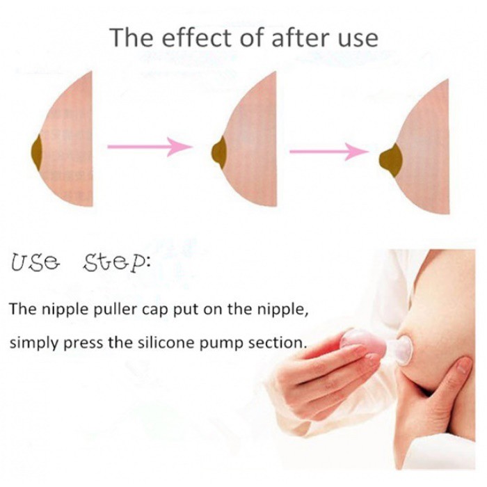 Pigeon Nipple Puller, Mengatasi Puting Datar