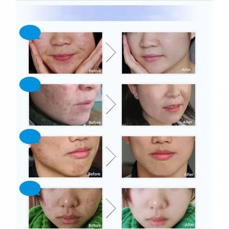 Medan Termurah Krim penghilang jerawat pure skin acne removal