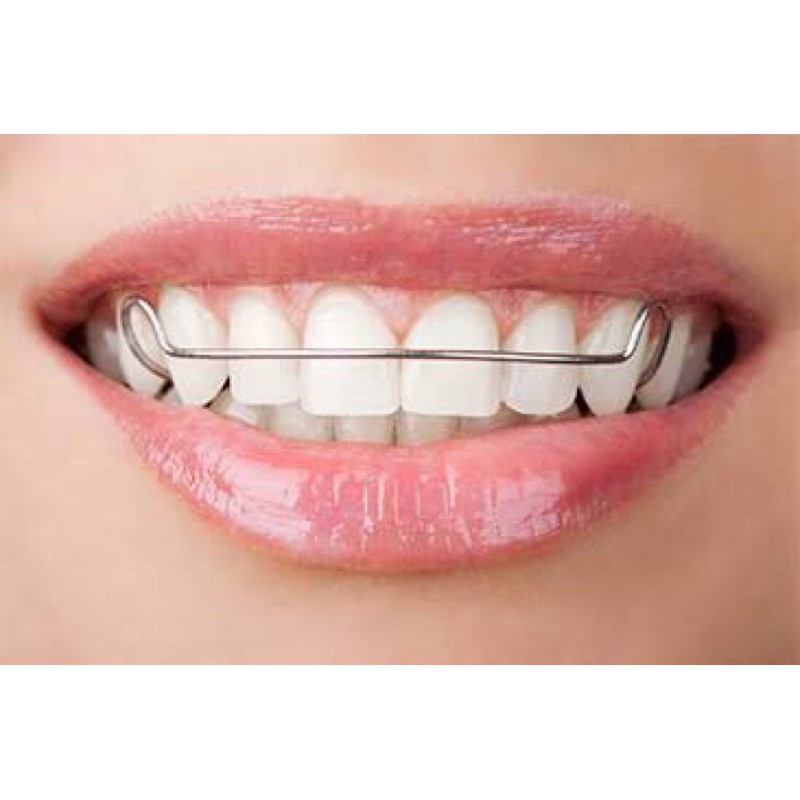 HAWLEY RETAINER - PENCEGAH GIGI BERANTAKAN