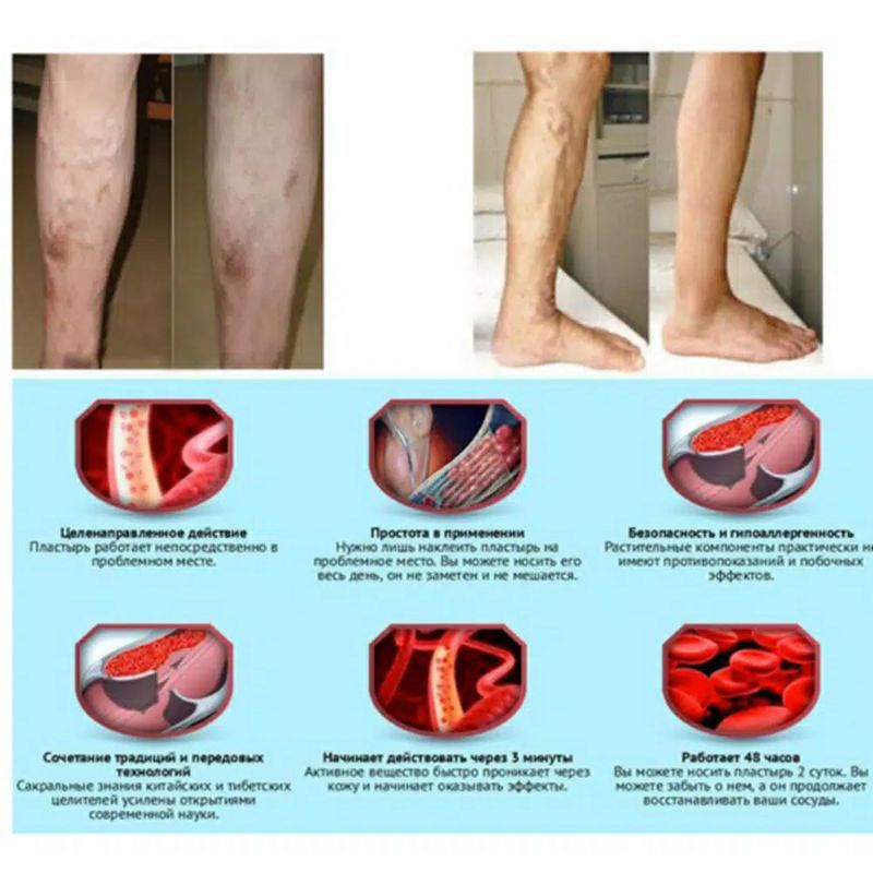 [ bisa COD] ~ SALEP PENGHILANG VARISES TRADITIONAL CHINA VARICOSE VEINS ORIGINAL