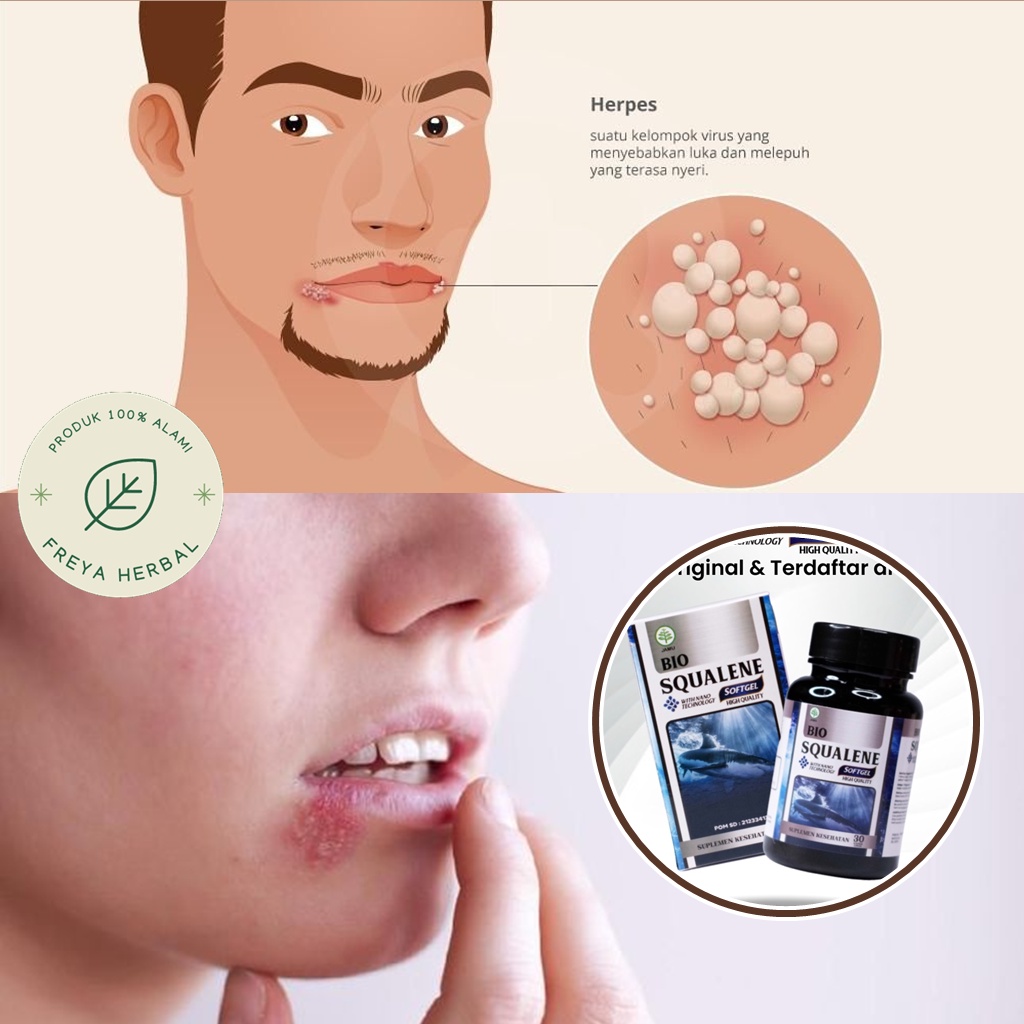 OBAT HERPES, OBAT HERBAL SIMPLEX, OBAT HERPES ZOSTER, OBAT HERPES GENITAL