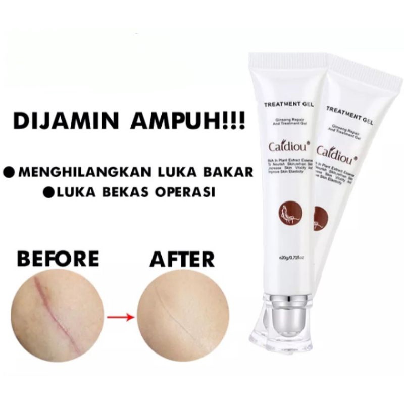 TREATMENT GEL CAIDIOU | GEL AMPUH HILANGKAN BEKAS LUKA |