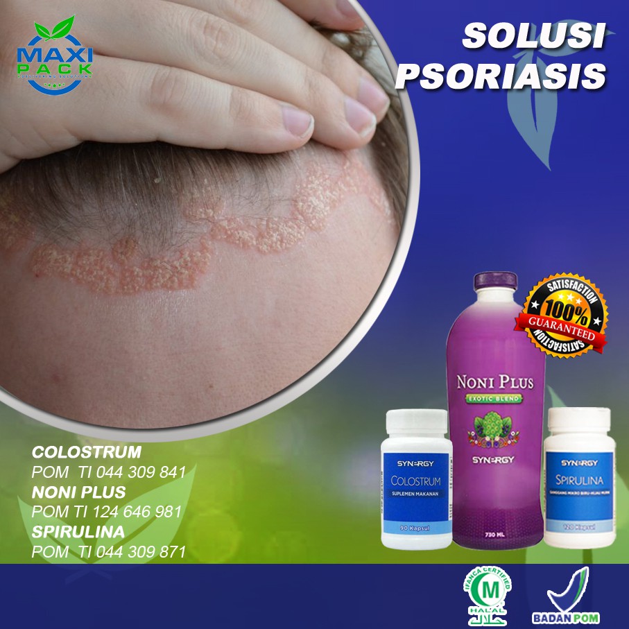 Therapy Kulit Kepala Bersisik Psoriasis AMAN Dan ALAMI