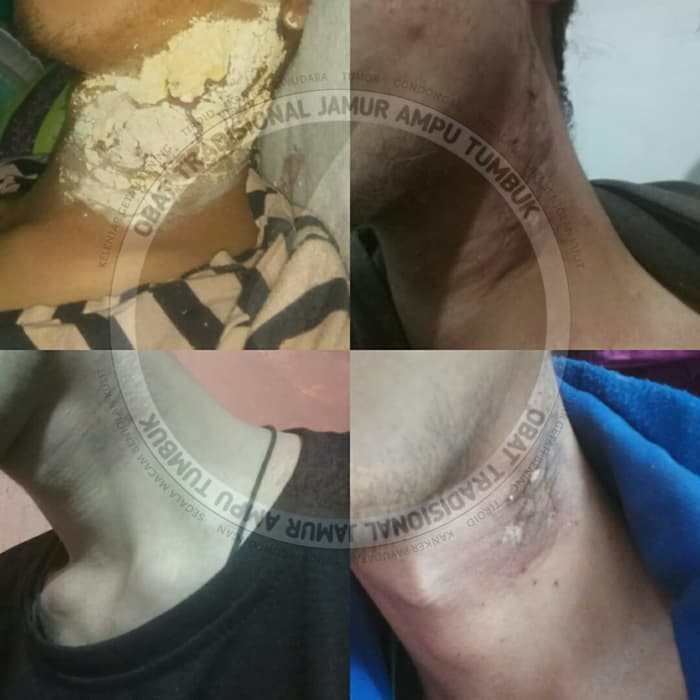 

Pelekat Rempah Alami Jamur Ampu Tumbuk Diskon