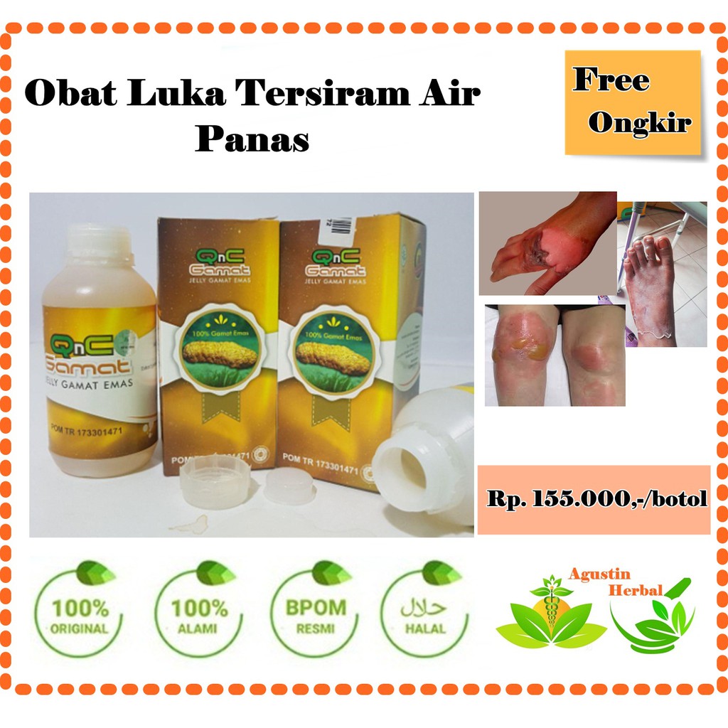 Obat Alami Untuk Luka Bakar Kena Air Panas