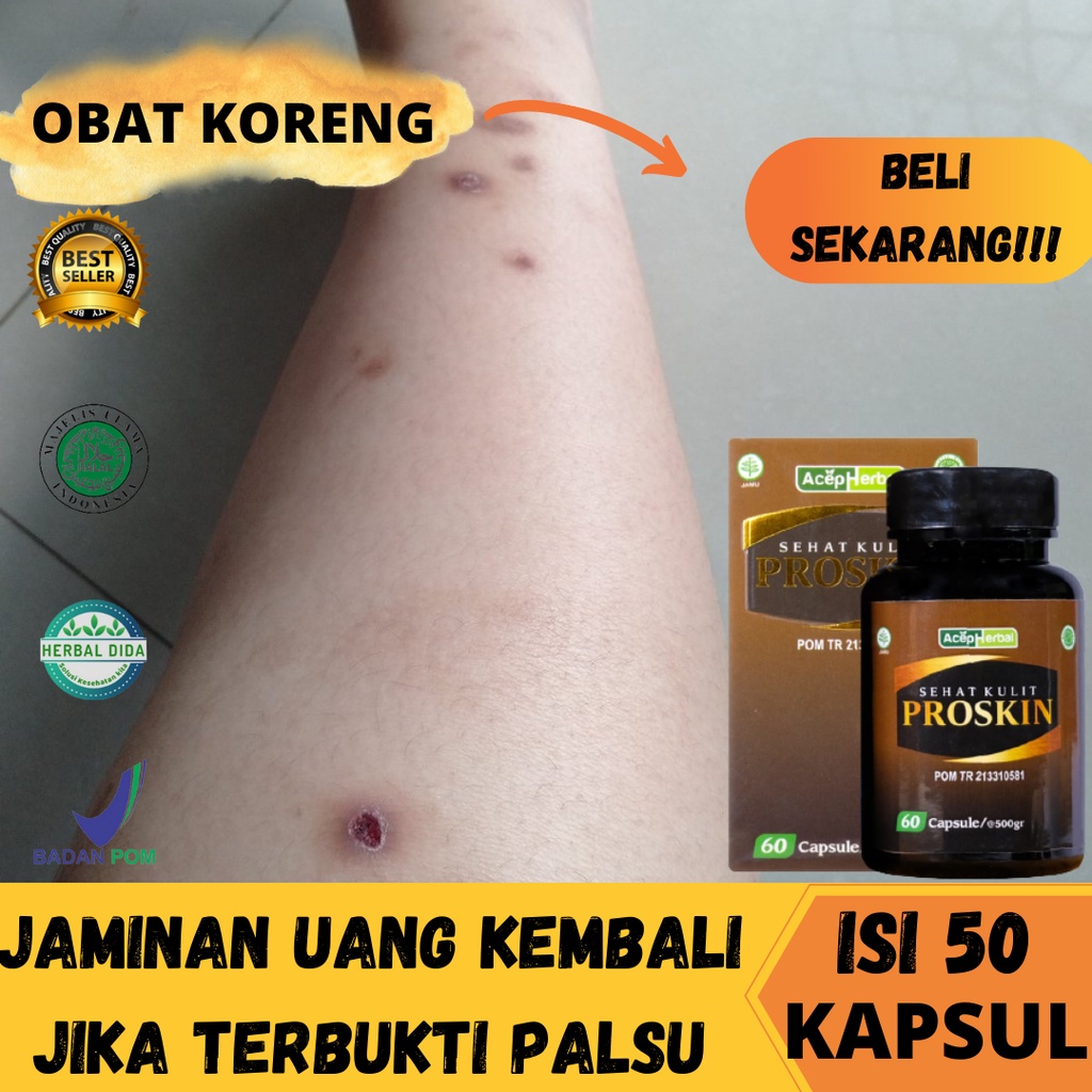 PROSKIN 100% ORIGINAL BPOM, Obat Koreng/Obat Luka, Obat Penghilang Bekas Luka Koreng, Obat Koreng di