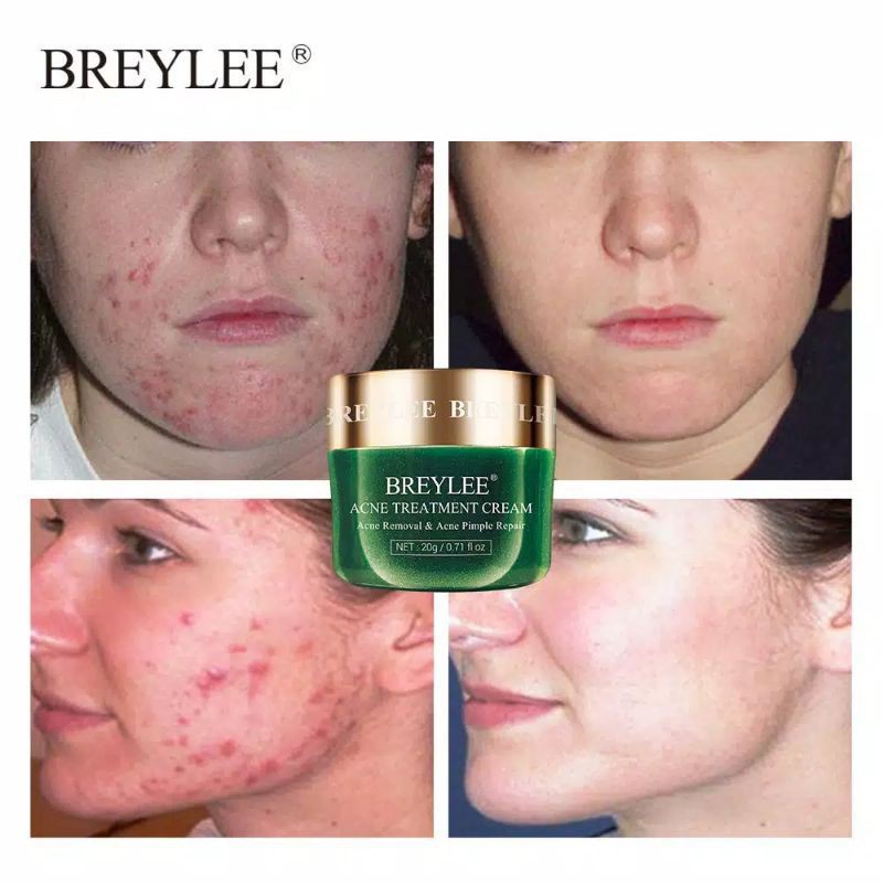 【asli】BREYLEE Acne Treatment Cream - Krim Jerawat &amp; Komedo Wajah , Memperbaiki Kulit &amp; Mengecilkan Pori Wajah (20 g)