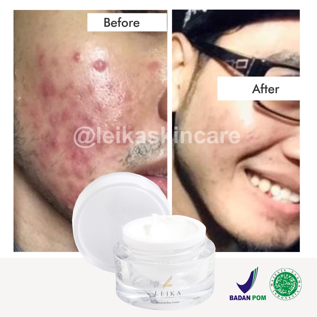 Krim Siang Penghilang Bekas Jerawat Ampuh BPOM Obat Penghilang Bekas Jerawat Pria Membandel Aman BPOM Penghilang Bekas Jerawat Penghilang Bopeng Bekas Jerawat Cream Penghilang Bekas Jerawat Day Cream Leika Skincare Penghilang Bekas Jerawat Pria Pembersi